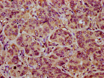 IHC image of CSB-PA015964LA01HU diluted at 1:200 and staining in paraffin-embedded human liver cancer performed on a Leica BondTM system. After dewaxing and hydration, antigen retrieval was mediated by high pressure in a citrate buffer (pH 6.0). S...