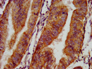 IHC image of CSB-PA015987LA01HU diluted at 1:500 and staining in paraffin-embedded human endometrial cancer performed on a Leica BondTM system. After dewaxing and hydration, antigen retrieval was mediated by high pressure in a citrate buffer (pH 6...