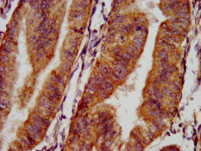 IHC image of CSB-PA015987LA01HU diluted at 1:500 and staining in paraffin-embedded human endometrial cancer performed on a Leica BondTM system. After dewaxing and hydration, antigen retrieval was mediated by high pressure in a citrate buffer (pH 6...
