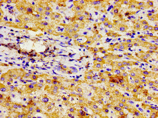 Immunohistochemistry of paraffin-embedded human liver cancer using CSB-PA016025LA01HU at dilution of 1:100