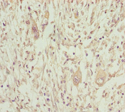Immunohistochemistry of paraffin-embedded human pancreatic cancer using CSB-PA016028ESR2HU at dilution of 1:100