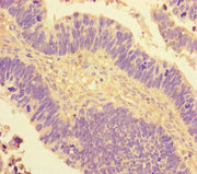 Immunohistochemistry of paraffin-embedded human ovarian cancer using CSB-PA016057LA01HU at dilution of 1:100