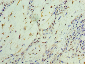 Immunohistochemistry of paraffin-embedded human breast cancer using CSB-PA016062ESR1HU at dilution of 1:100