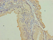 Immunohistochemistry of paraffin-embedded human prostate cancer using CSB-PA016069LA01HU at dilution of 1:100