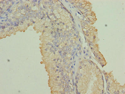 Immunohistochemistry of paraffin-embedded human prostate cancer using CSB-PA016069LA01HU at dilution of 1:100