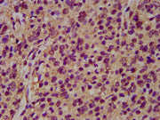 IHC image of CSB-PA016074LA01HU diluted at 1:200 and staining in paraffin-embedded human glioma performed on a Leica BondTM system. After dewaxing and hydration, antigen retrieval was mediated by high pressure in a citrate buffer (pH 6.0). Section...