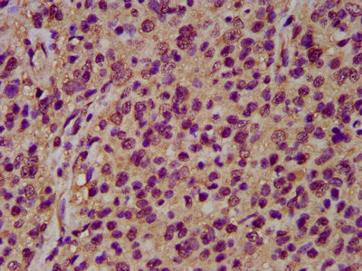 IHC image of CSB-PA016074LA01HU diluted at 1:200 and staining in paraffin-embedded human glioma performed on a Leica BondTM system. After dewaxing and hydration, antigen retrieval was mediated by high pressure in a citrate buffer (pH 6.0). Section...