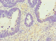 Immunohistochemistry of paraffin-embedded human ovarian cancer using CSB-PA016214ESR1HU at dilution of 1:100