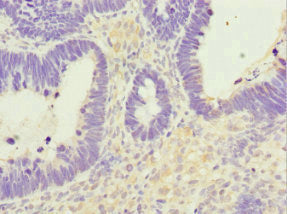 Immunohistochemistry of paraffin-embedded human ovarian cancer using CSB-PA016214ESR1HU at dilution of 1:100