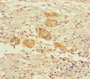 Immunohistochemistry of paraffin-embedded human pancreatic cancer using CSB-PA016307LA01HU at dilution of 1:100