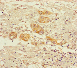 Immunohistochemistry of paraffin-embedded human pancreatic cancer using CSB-PA016307LA01HU at dilution of 1:100