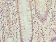 Immunohistochemistry of paraffin-embedded human colon cancer using CSB-PA016348ESR1HU at dilution of 1:100