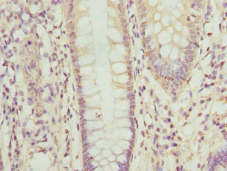 Immunohistochemistry of paraffin-embedded human colon cancer using CSB-PA016348ESR1HU at dilution of 1:100