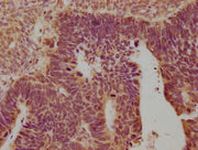 IHC image of CSB-PA016359OA01HU diluted at 1:100 and staining in paraffin-embedded human ovarian cancer performed on a Leica BondTM system. After dewaxing and hydration, antigen retrieval was mediated by high pressure in a citrate buffer (pH 6.0)....