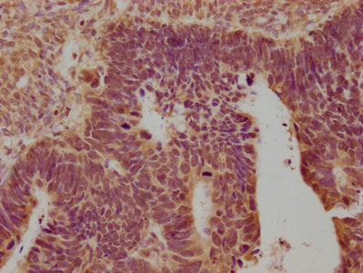 IHC image of CSB-PA016359OA01HU diluted at 1:100 and staining in paraffin-embedded human ovarian cancer performed on a Leica BondTM system. After dewaxing and hydration, antigen retrieval was mediated by high pressure in a citrate buffer (pH 6.0)....