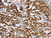 The image is immunohistochemistry of paraffin-embedded Human thyroid cancer tissue using CSB-PA016408(IGF2R Antibody) at dilution 1/40. (Original magnification: ×200)
