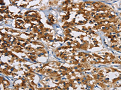 The image is immunohistochemistry of paraffin-embedded Human thyroid cancer tissue using CSB-PA016408(IGF2R Antibody) at dilution 1/40. (Original magnification: ×200)