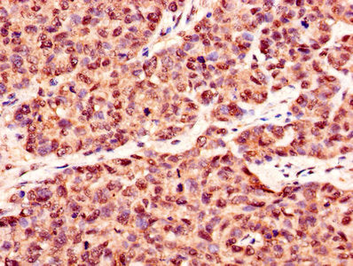 Immunohistochemistry of paraffin-embedded human ovarian cancer using CSB-PA01655A0Rb at dilution of 1:100