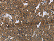 The image on the left is immunohistochemistry of paraffin-embedded Human ovarian cancer tissue using CSB-PA016594(LAIR2 Antibody) at dilution 1/20, on the right is treated with synthetic peptide. (Original magnification: ×200)
