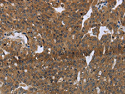The image on the left is immunohistochemistry of paraffin-embedded Human ovarian cancer tissue using CSB-PA016594(LAIR2 Antibody) at dilution 1/20, on the right is treated with synthetic peptide. (Original magnification: ×200)