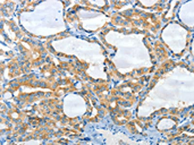 The image on the left is immunohistochemistry of paraffin-embedded Human thyroid cancer tissue using CSB-PA016618(CNTNAP3 Antibody) at dilution 1/30, on the right is treated with synthetic peptide. (Original magnification: ×200)