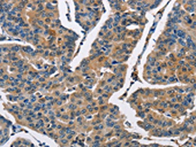 The image on the left is immunohistochemistry of paraffin-embedded Human breast cancer tissue using CSB-PA016670(CBR1 Antibody) at dilution 1/40, on the right is treated with fusion protein. (Original magnification: ×200)