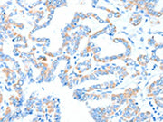 The image on the left is immunohistochemistry of paraffin-embedded Human thyroid cancer tissue using CSB-PA016752(GPT Antibody) at dilution 1/55, on the right is treated with synthetic peptide. (Original magnification: ×200)