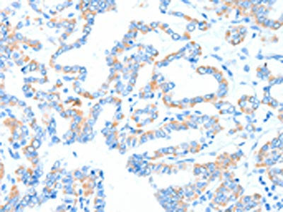 The image on the left is immunohistochemistry of paraffin-embedded Human thyroid cancer tissue using CSB-PA016752(GPT Antibody) at dilution 1/55, on the right is treated with synthetic peptide. (Original magnification: ×200)