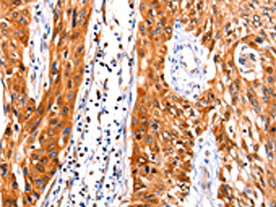 The image on the left is immunohistochemistry of paraffin-embedded Human esophagus cancer tissue using CSB-PA016832(FBLN1 Antibody) at dilution 1/47, on the right is treated with synthetic peptide. (Original magnification: ×200)