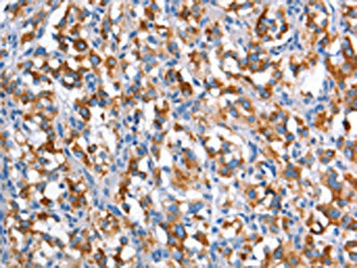 The image on the left is immunohistochemistry of paraffin-embedded Human thyroid cancer tissue using CSB-PA016936(CD226 Antibody) at dilution 1/60, on the right is treated with synthetic peptide. (Original magnification: ×200)
