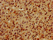 IHC image of CSB-PA01694A0Rb diluted at 1:600 and staining in paraffin-embedded human glioma performed on a Leica BondTM system. After dewaxing and hydration, antigen retrieval was mediated by high pressure in a citrate buffer (pH 6.0). Section wa...