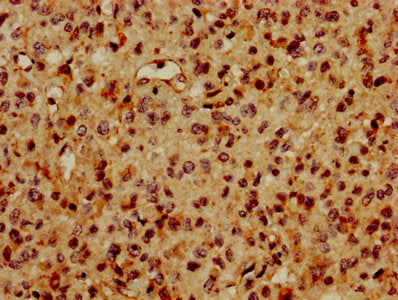 IHC image of CSB-PA01694A0Rb diluted at 1:600 and staining in paraffin-embedded human glioma performed on a Leica BondTM system. After dewaxing and hydration, antigen retrieval was mediated by high pressure in a citrate buffer (pH 6.0). Section wa...