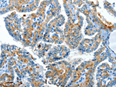 The image on the left is immunohistochemistry of paraffin-embedded Human thyroid cancer tissue using CSB-PA017010(CLPTM1L Antibody) at dilution 1/60, on the right is treated with synthetic peptide. (Original magnification: ×200)