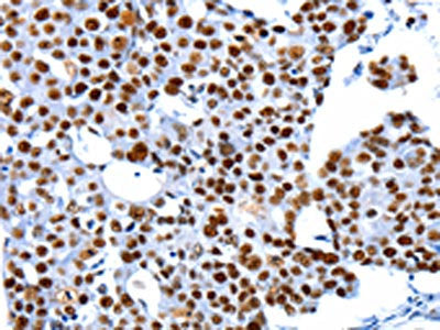 The image on the left is immunohistochemistry of paraffin-embedded Human breast cancer tissue using CSB-PA017043(HDAC2 Antibody) at dilution 1/17, on the right is treated with synthetic peptide. (Original magnification: ×200)