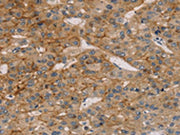 The image on the left is immunohistochemistry of paraffin-embedded Human liver cancer tissue using CSB-PA017058(TM4SF1 Antibody) at dilution 1/25, on the right is treated with synthetic peptide. (Original magnification: ×200)