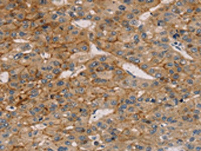 The image on the left is immunohistochemistry of paraffin-embedded Human liver cancer tissue using CSB-PA017058(TM4SF1 Antibody) at dilution 1/25, on the right is treated with synthetic peptide. (Original magnification: ×200)