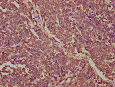 IHC image of CSB-PA017237LA01HU diluted at 1:320 and staining in paraffin-embedded human lung cancer performed on a Leica BondTM system. After dewaxing and hydration, antigen retrieval was mediated by high pressure in a citrate buffer (pH 6.0). Se...