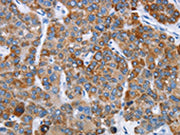 The image on the left is immunohistochemistry of paraffin-embedded Human liver cancer tissue using CSB-PA017354(CHDH Antibody) at dilution 1/20, on the right is treated with fusion protein. (Original magnification: ×200)