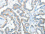 The image on the left is immunohistochemistry of paraffin-embedded Human thyroid cancer tissue using CSB-PA017442(ADRA1A Antibody) at dilution 1/40, on the right is treated with synthetic peptide. (Original magnification: ×200)