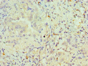 Immunohistochemistry of paraffin-embedded human lung cancer using CSB-PA017492DSR1HU at dilution of 1:100