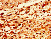 Immunohistochemistry of paraffin-embedded human melanoma using CSB-PA017495LA01HU at dilution of 1:100
