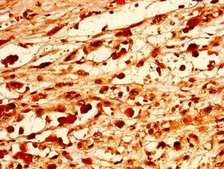 Immunohistochemistry of paraffin-embedded human melanoma using CSB-PA017495LA01HU at dilution of 1:100
