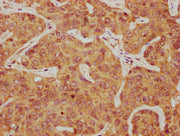 IHC image of CSB-PA017536LA01HU diluted at 1:300 and staining in paraffin-embedded human liver cancer performed on a Leica BondTM system. After dewaxing and hydration, antigen retrieval was mediated by high pressure in a citrate buffer (pH 6.0). S...