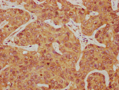 IHC image of CSB-PA017536LA01HU diluted at 1:300 and staining in paraffin-embedded human liver cancer performed on a Leica BondTM system. After dewaxing and hydration, antigen retrieval was mediated by high pressure in a citrate buffer (pH 6.0). S...