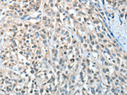 The image on the left is immunohistochemistry of paraffin-embedded Human esophagus cancer tissue using CSB-PA017539(AGBL3 Antibody) at dilution 1/25, on the right is treated with fusion protein. (Original magnification: ×200)