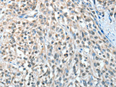 The image on the left is immunohistochemistry of paraffin-embedded Human esophagus cancer tissue using CSB-PA017539(AGBL3 Antibody) at dilution 1/25, on the right is treated with fusion protein. (Original magnification: ×200)