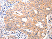 The image on the left is immunohistochemistry of paraffin-embedded Human ovarian cancer tissue using CSB-PA017573(VTCN1 Antibody) at dilution 1/20, on the right is treated with synthetic peptide. (Original magnification: ×200)