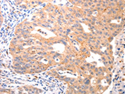 The image on the left is immunohistochemistry of paraffin-embedded Human ovarian cancer tissue using CSB-PA017573(VTCN1 Antibody) at dilution 1/20, on the right is treated with synthetic peptide. (Original magnification: ×200)