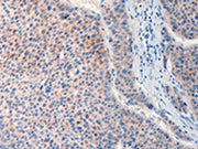 The image on the left is immunohistochemistry of paraffin-embedded Human liver cancer tissue using CSB-PA017577(FAT4 Antibody) at dilution 1/20, on the right is treated with synthetic peptide. (Original magnification: ×200)
