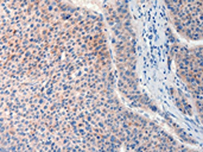 The image on the left is immunohistochemistry of paraffin-embedded Human liver cancer tissue using CSB-PA017577(FAT4 Antibody) at dilution 1/20, on the right is treated with synthetic peptide. (Original magnification: ×200)